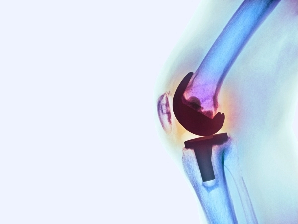 Clasificación de prótesis de rodilla total