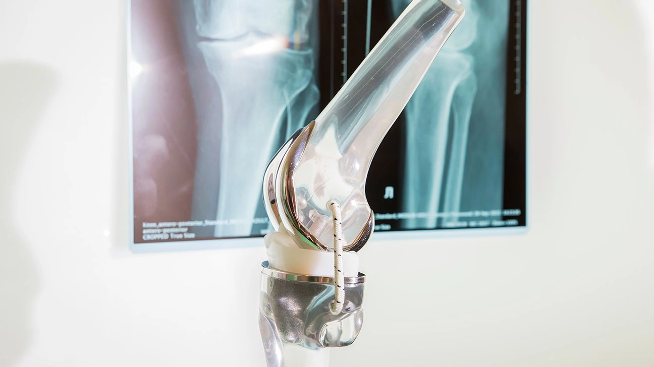 Knee Implant Types Materials Precision