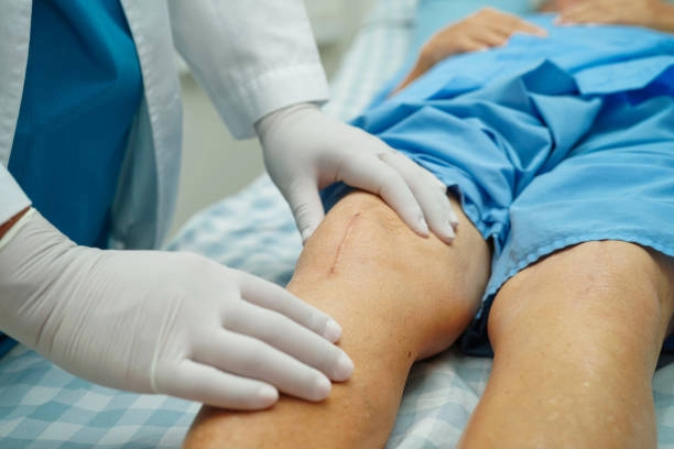 Knee Replacement Surgery Criteria