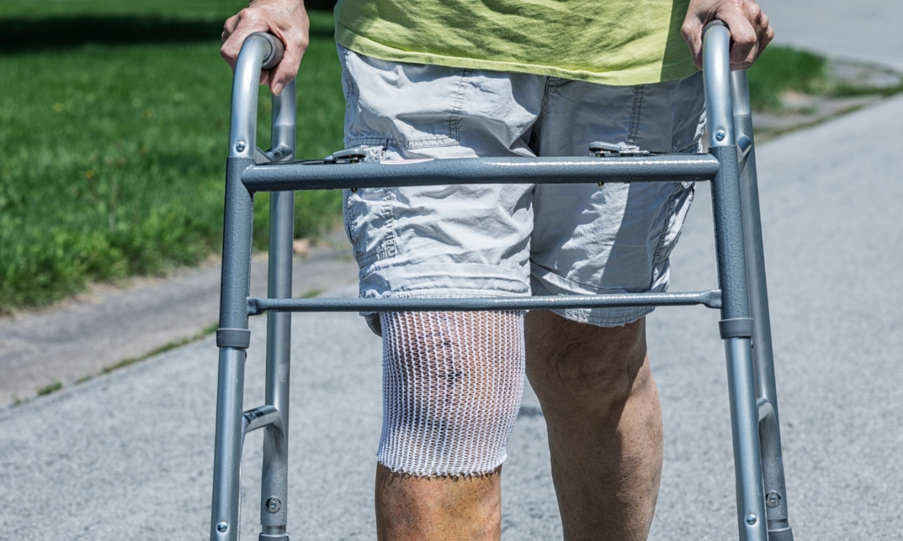 Prosthetic Knee Replacement Cost Factors